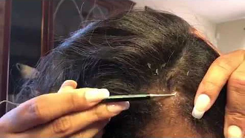 Extreme Dandruff Scratching - Extreme Flakes, Pt. 1