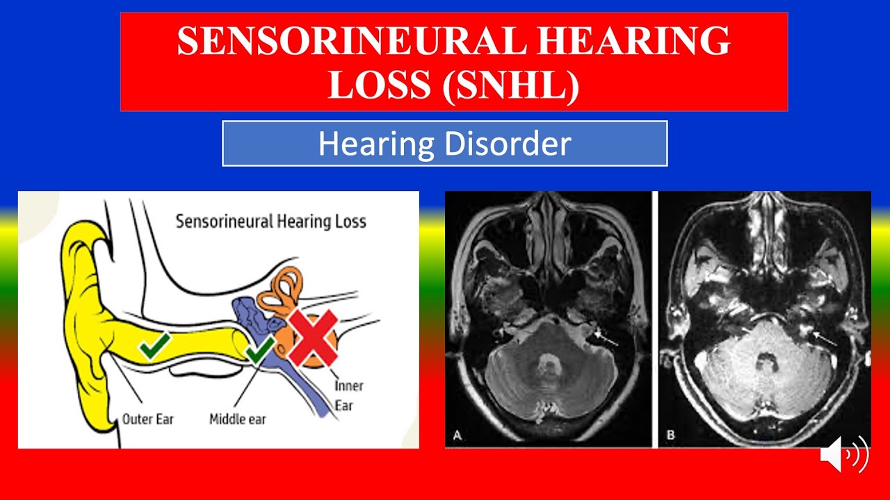 SENSORINEURAL HEARING LOSS (SNHL) -Definition, types, cusses ...