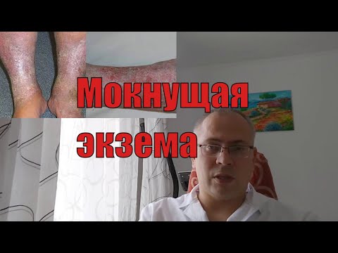 Мокнущая экзема - фото, симптомы, лечение мокнущей экземы