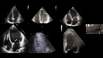 Che cos'è una cardiopatia dilatativa?