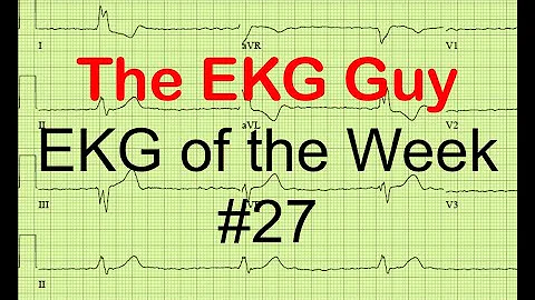 EKG/ECG of the Week #27 l The EKG Guy - www.ekg.md