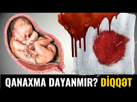 Video: Küret sonsuzluğa səbəb ola bilərmi?