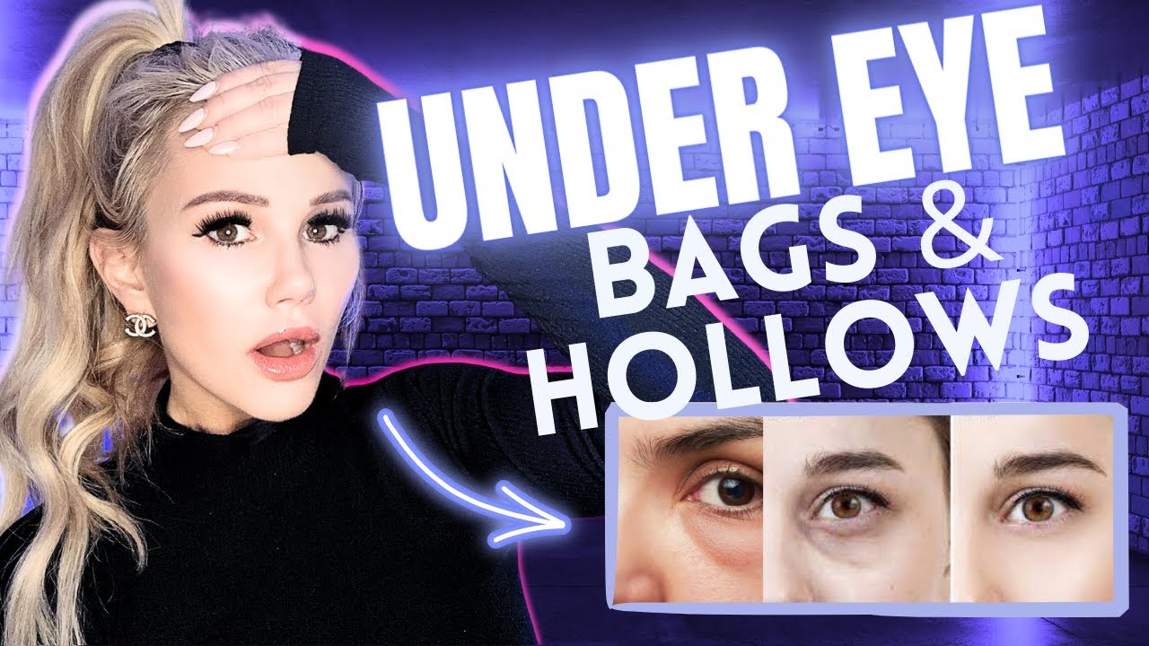 How to REMOVE UnderEye Bags & Hollows (best treatments) YouTube