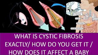 WHAT IS CYSTIC FIBROSIS EXACTLY ! HOW DO YOU GET IT ! HOW DOES IT AFFECT A BABY