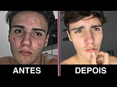 COMO FIQUEI SEM ESPINHAS EM 15 DIAS