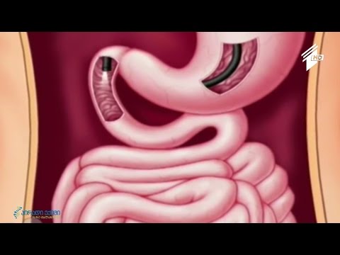 სისხლდენა თორმეტგოჯა ნაწლავიდან და კუჭიდან