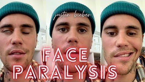 Justin Bieber cancels shows after half of face left paralysed by virus || #justinbieber ||