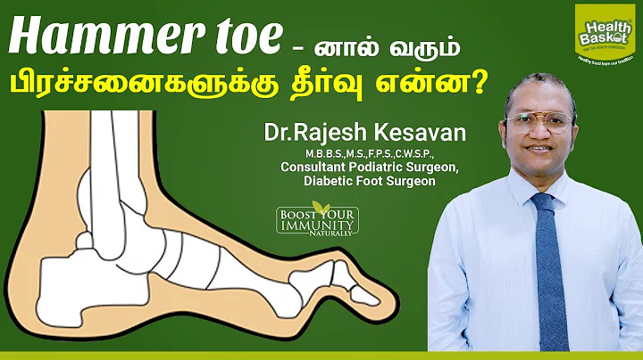 Hammer Toe - Problem & Solution | Dr.Rajesh Kesava...