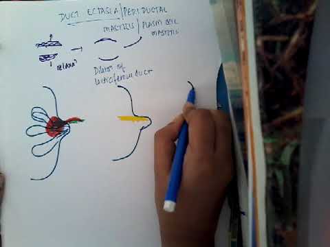 Video: Duct Ectasia Of The Breast: Gejala, Penyebab, Dan Perawatan