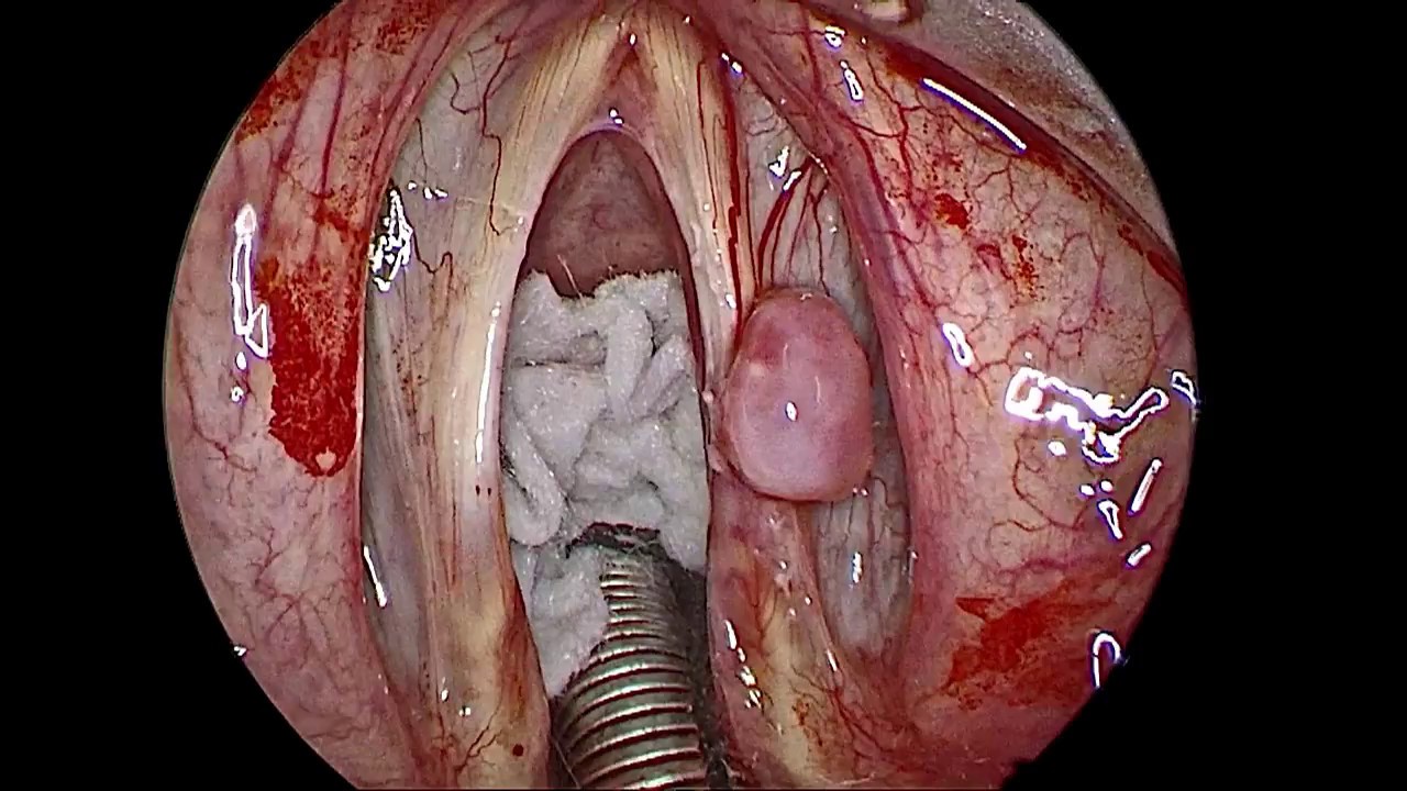 BEST ENT DOCTOR IN MUMBAI-INDIA, Laser Microlaryngoscopy