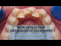 Non-extraction orthodontic treatment (Pt B.E.)