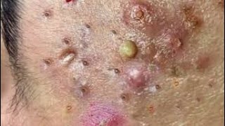 blackheads whiteheads,big cystic