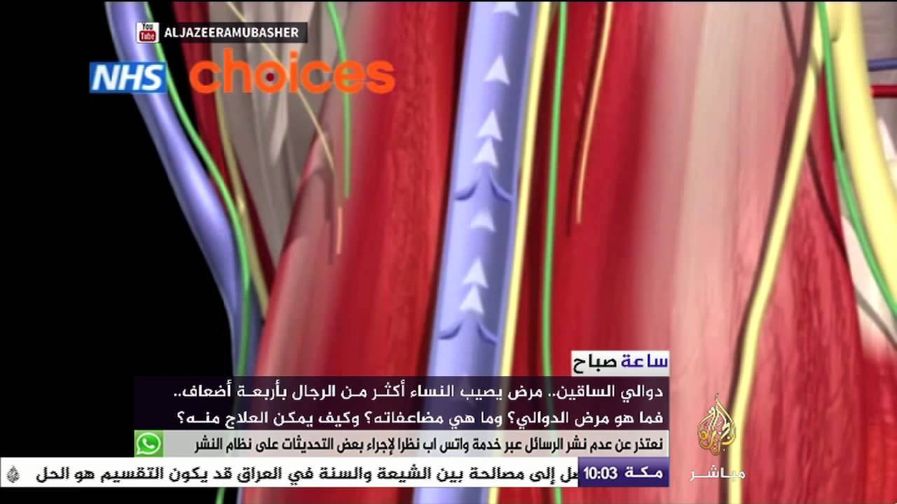 تقرير دوالي الساقين.. مرض يصيب النساء أكثر من الرجال