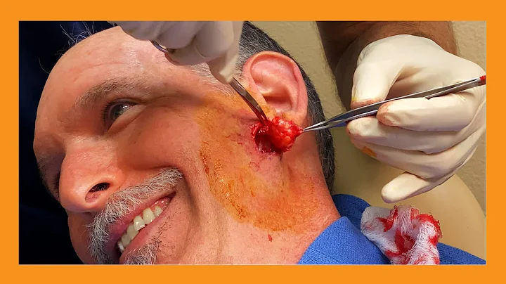 Dr. Fife squeezes Dr. Vaughan's Cyst | Auburn Medi...