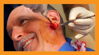 Dr. Fife squeezes Dr. Vaughan's Cyst | Auburn Medical Group