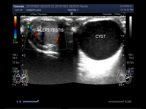 2016 Icd 10 Code For Epididymal Cyst