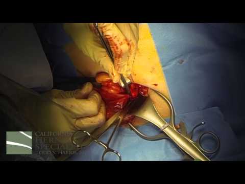 Open Inguinal Hernia Repair at California Hernia Specialists