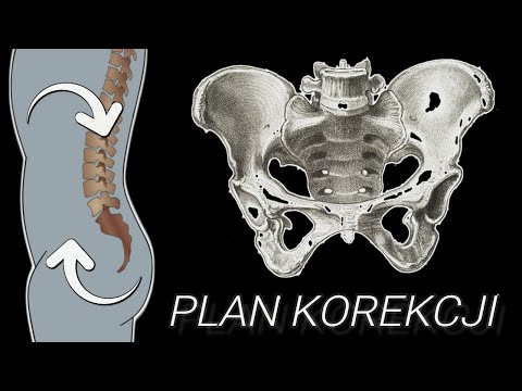 Wideo: 3 sposoby na rozpoznanie choroby zapalnej miednicy (PID)