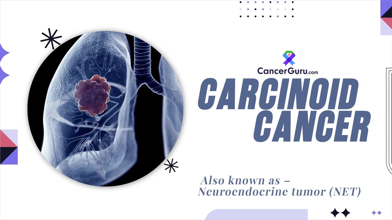 The Shocking Truth About Carcinoid Tumors You Need to Know Now - YouTube