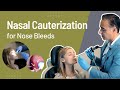 Nasal Cauterization For Nose Bleeds Epistaxis Nose Bleed Treatment Nasal Cauterization For Nose Bleeds Epistaxis Nose Bleed Treatment