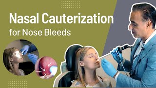 Nasal Cauterization for Nose Bleeds (Epistaxis) | Nose Bleed Treatment