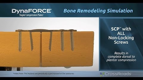 How Do DynaForce™ Staple Compression Plates™(SCP) Work?  - Gap Recovery, Apposition, Speed