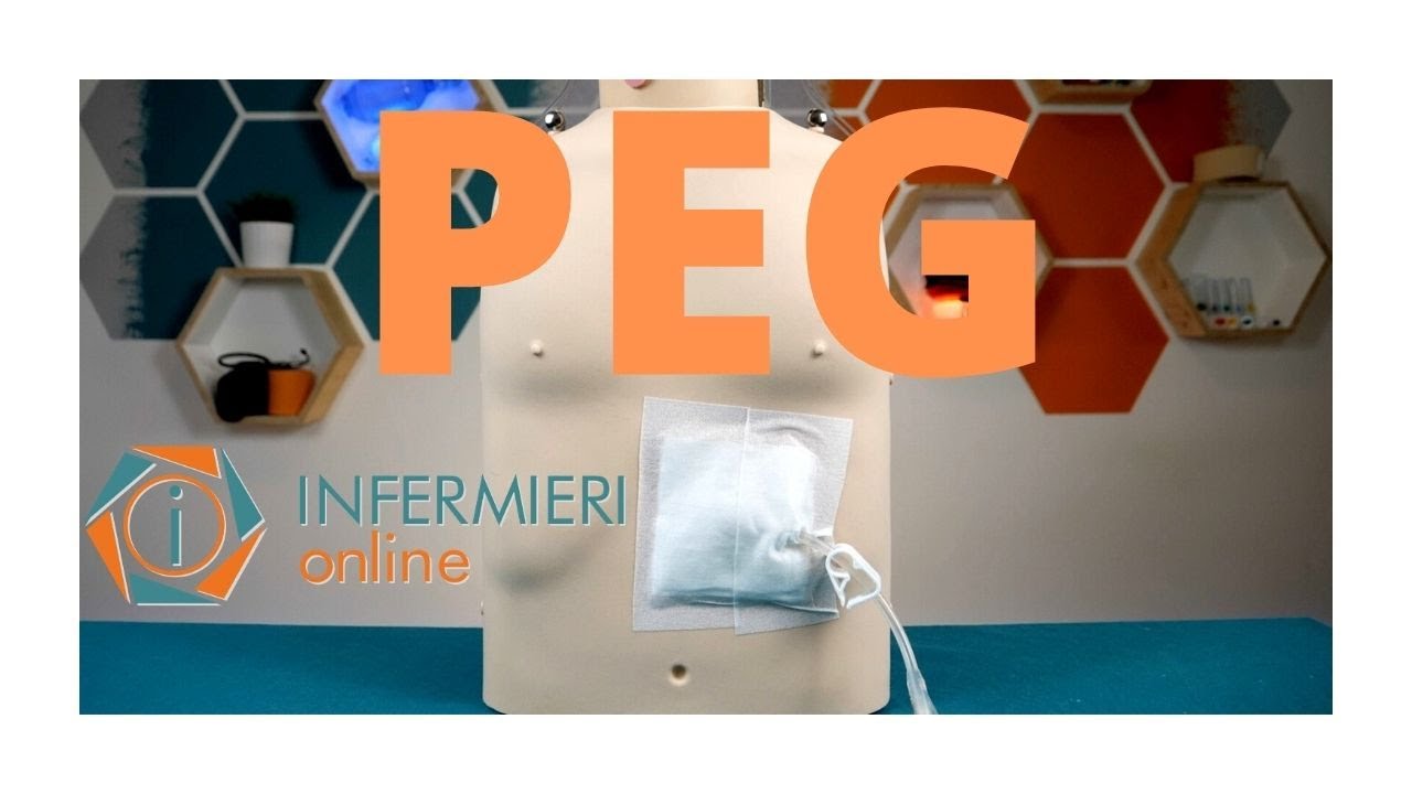 PEG | GESTIONE E MEDICAZIONE| Gastrostomia Endoscopica Percutanea | LA NUTRIZIONE ENTERALE