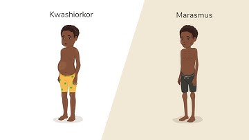 What is Malnutrition?