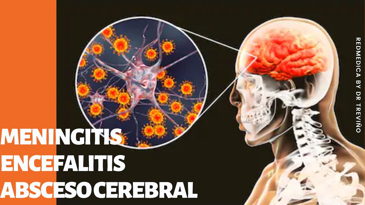 Meningitis, encefalitis y absceso cerebral 