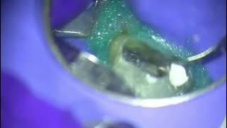 Separated File Removal with the LASCHAL® FXP System