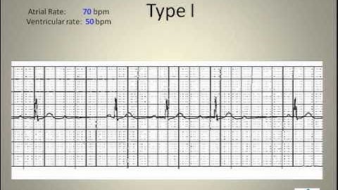 ECG Interpretation Video Lecture Module 6 of 6