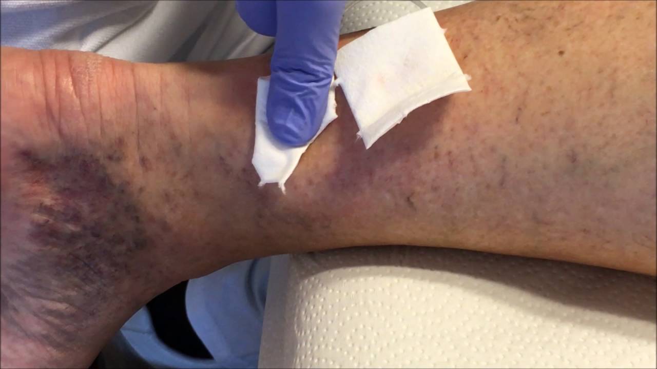 Mein Film sklerosierung - YouTube