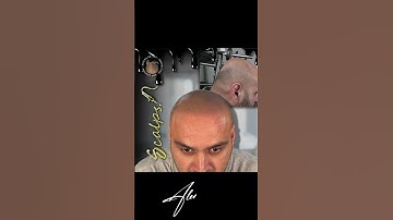 Another beautiful Scalp Micropigmentation Transformation Result