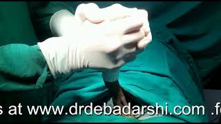 Stapler Circision By Dr Debadarshi Rath