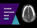 Cerebral aneurysmal bleed thereportingroom