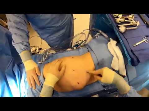 Port Placement for Robotic Lobectomy