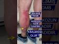 septiki tromboflebit septik tromb irinli tromboz infeksiyalaşma irinləmə flebotromboz fleboloq damar