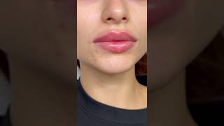 Контурная пластика губ🌿 1 мл филлера