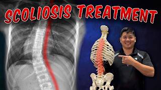 Scoliosis: The Most Effective Way to Treat It | Doctor Explains