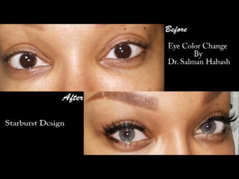 brightocular eye color change surgery starburst design by drsalman habash - Eye Color Change Surgery Before And After brightocular eye color change surgery starburst design by drsalman habash - Eye Color Change Surgery Before And After