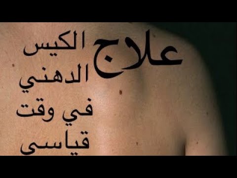 ما هو الكيس الدهني في الظهر