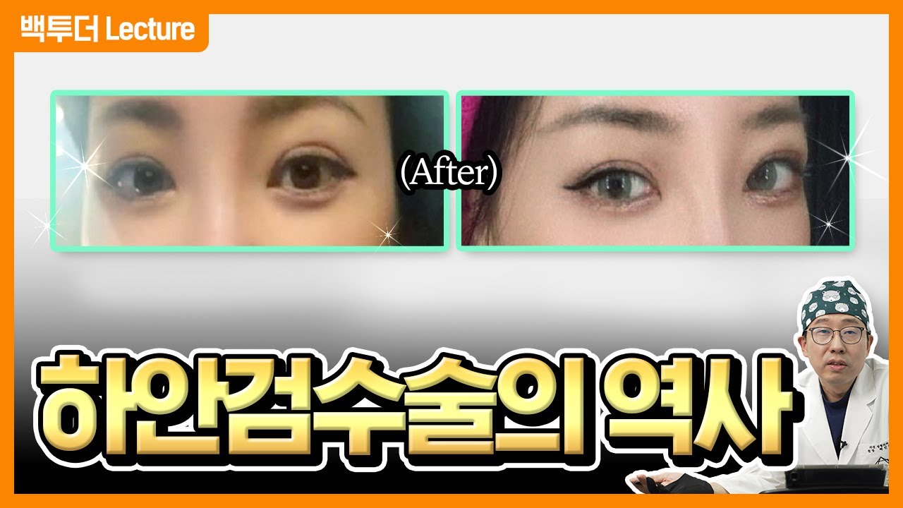 하안검 수술의 역사, 0단계부터 4단계 쿼드플러스하안검까지