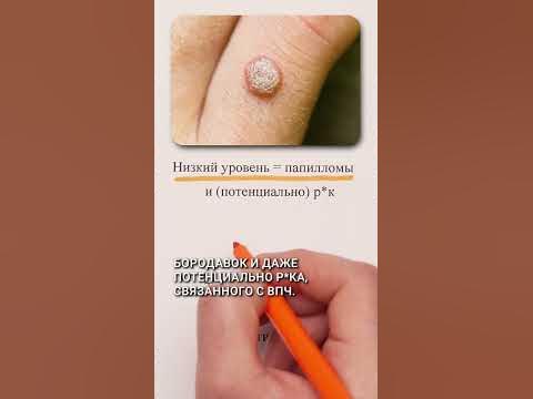 🦠Против папиллом - YouTube