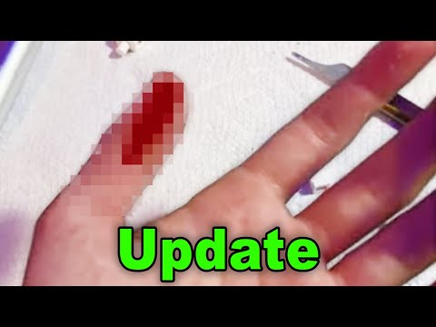 LEGO Streaming Injury Update