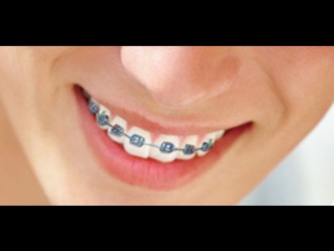 Imagenes de brackets originales