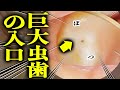 ナメたらあかん 小さな穴が歯を決壊するほど強烈な虫歯に成長します それを食い止める お口最後の防御壁 歯医者かおりです