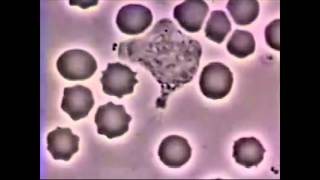 Surviving Sepsis: Saving Lives with Stem Cells - St. Michael's Angels' Den