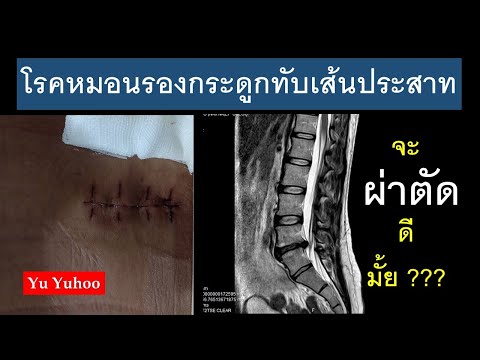 โรคหมอนรองกระดูกทับเสันประสาท (Herniated disc) จะผ่าตัดดีมั้ย??