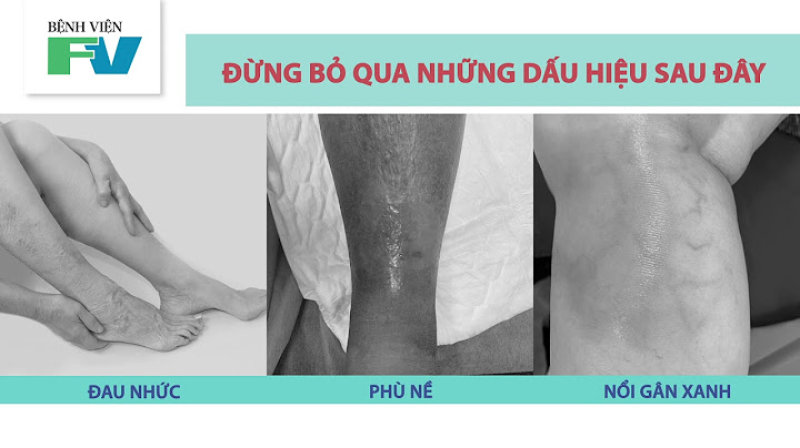 Dấu hiệu bị giãn tĩnh mạch ở chân