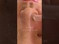 【白く浮き出る毛穴洗浄】1度で黒ずみ角栓をごっそり吸引👃🏻